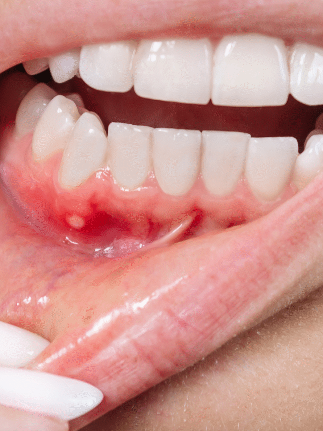 मुंह के छालों से तुरंत राहत पाने के लिए आज़माएं ये घरेलू टिप्स